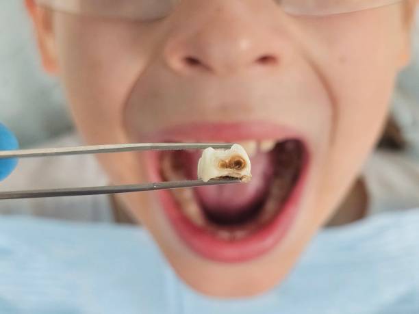 Best Emergency Dental Care for Broken or Chipped Teeth in Rockwell City, IA